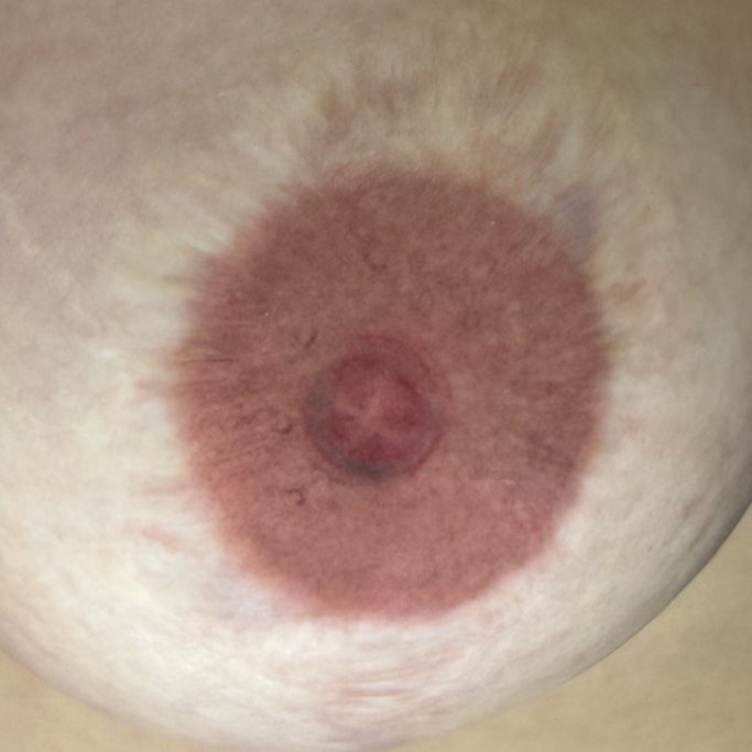 Brustwarzenrekonstruktion Nachher