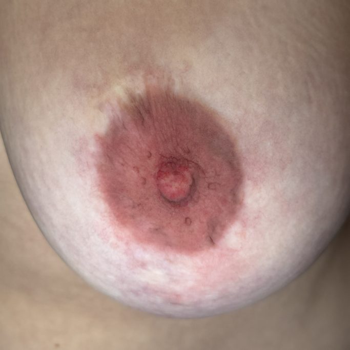 Brustwarzenrekonstruktion Nachher