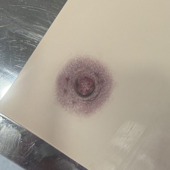 Brustwarzenrekonstruktion Beispiele