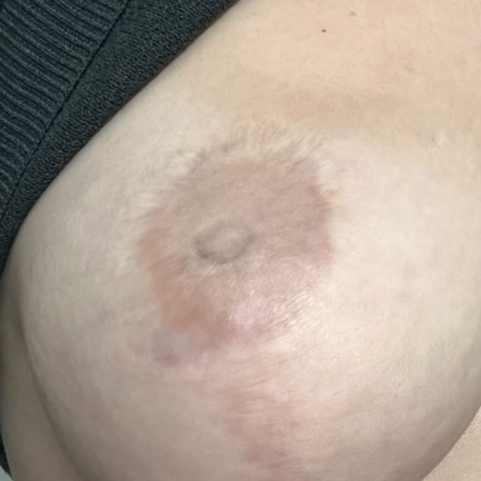 Brustwarzenrekonstruktion Vorher