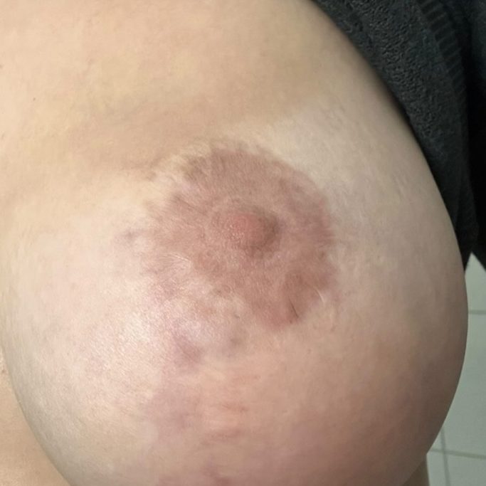 Brustwarzenrekonstruktion Vorher