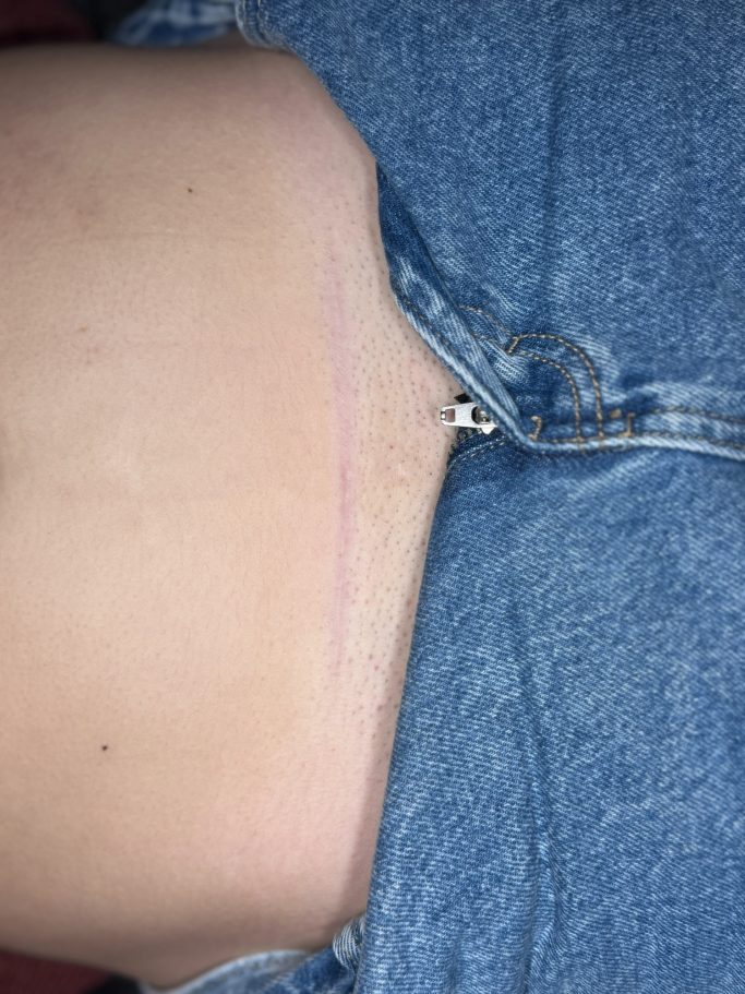 Narbenabdeckung nachher