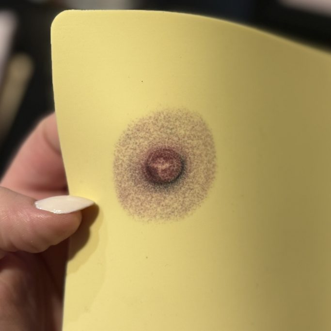 Brustwarzenrekonstruktion Beispiele